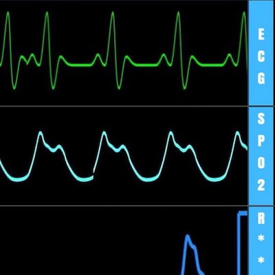 Heart Rate Ranges in Neonates